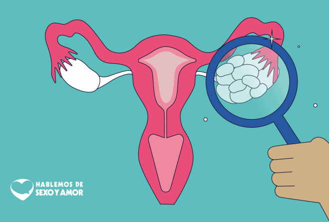 Ovarios poliquísticos: más que un mal menor